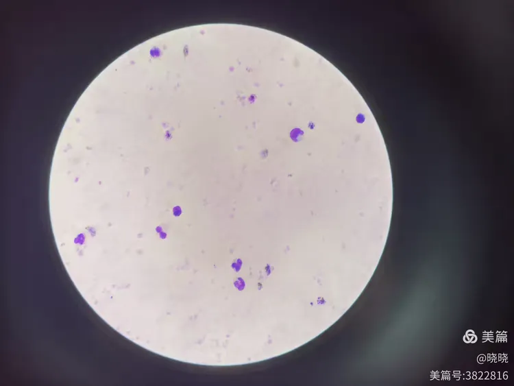 三种疟原虫厚膜染色法对比